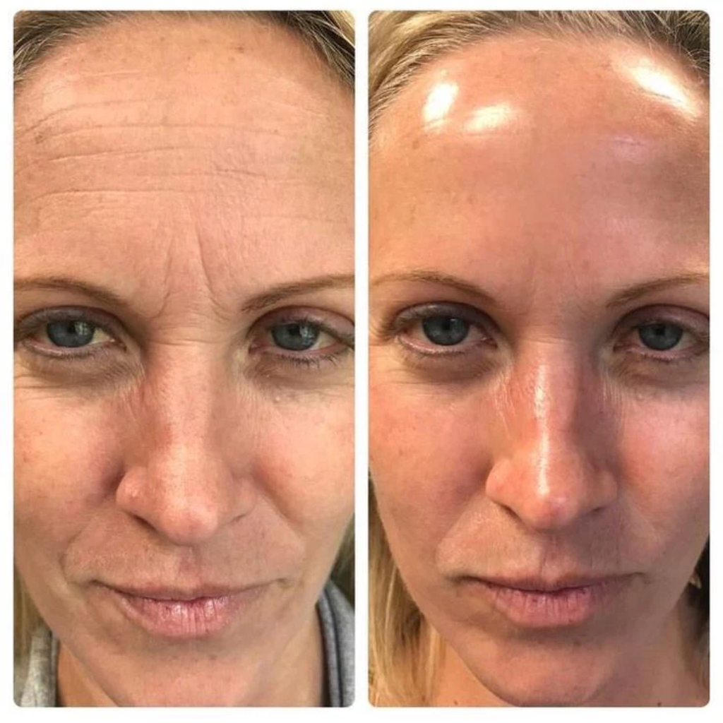 Fiorea™ Retinal Shot - Adiós Arrugas