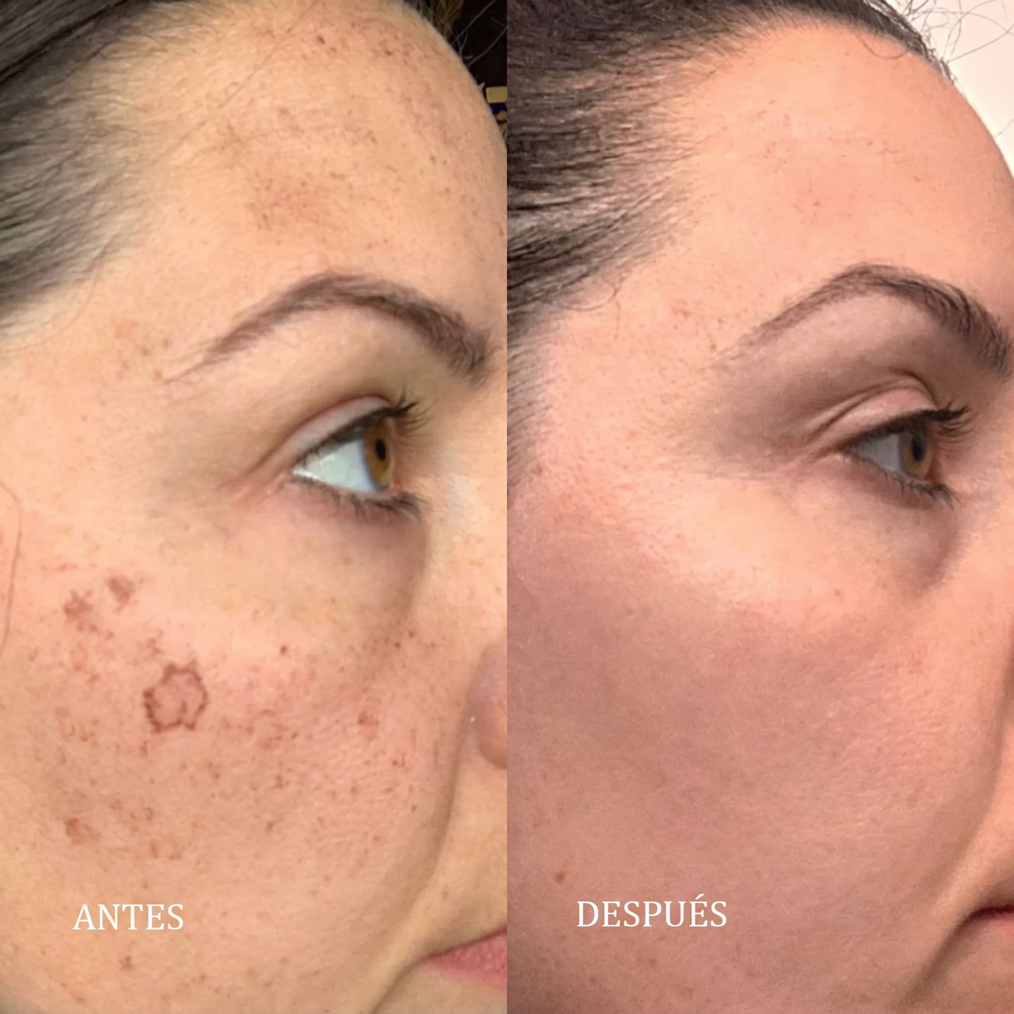 Fiorea® Crema TXN - Adiós Manchas