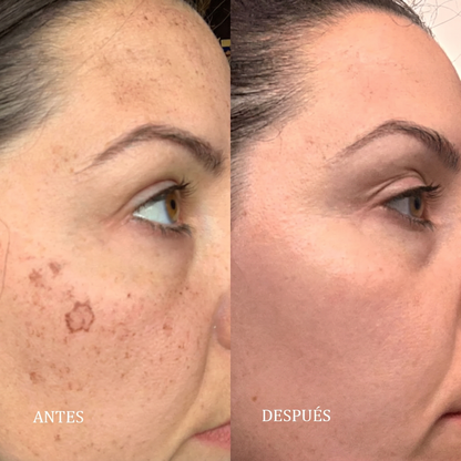 Fiorea® Crema TXN - Adiós Manchas