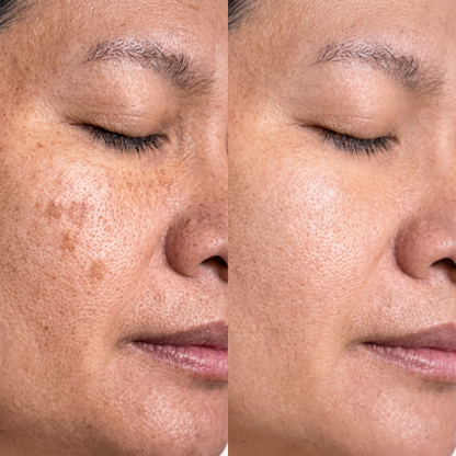 Fiorea® Crema TXN - Adiós Manchas